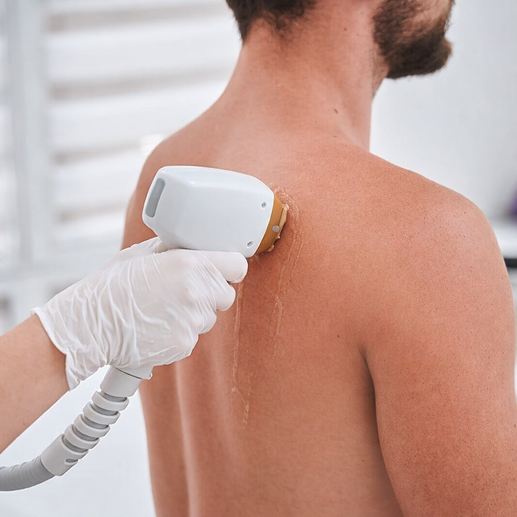 Épilation laser homme à Arthès – zones & tarifs